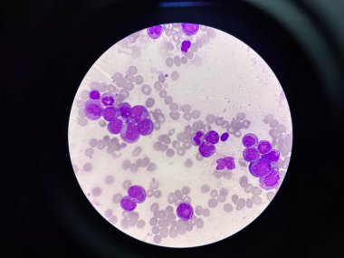 Immature leukemic cell in leukemia blood smear. clipart