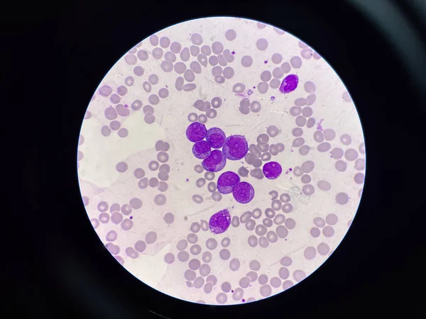 Células Leucémicas Inmaduras Leucemia Frotis Sangre — Foto de Stock
