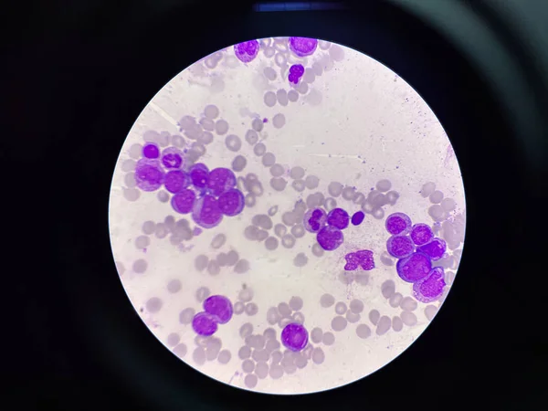 Niedojrzałe Komórki Białaczkowe Białaczce Rozmaz Krwi — Zdjęcie stockowe