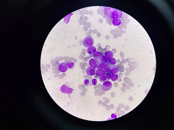 白血病血液涂片中的不成熟白血病细胞 — 图库照片