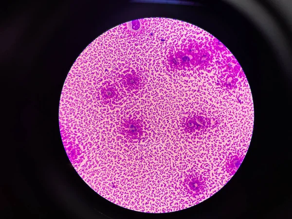滑膜体液中的白细胞 — 图库照片