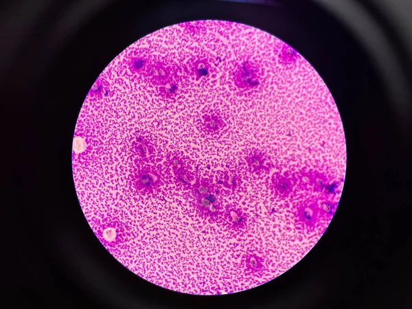 滑膜体液中的白细胞 — 图库照片