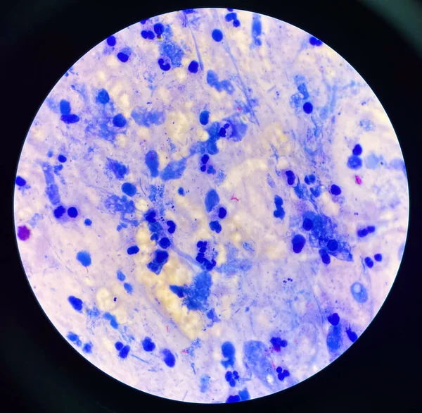 Matige Rode Cel Centrum Mycobacterium Tuberculosis Bacteriën — Stockfoto