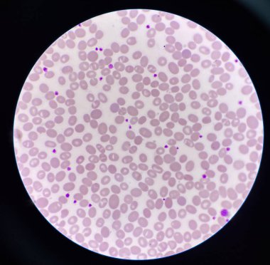 Blood smear Abnormal cell macro ovalocyte. clipart