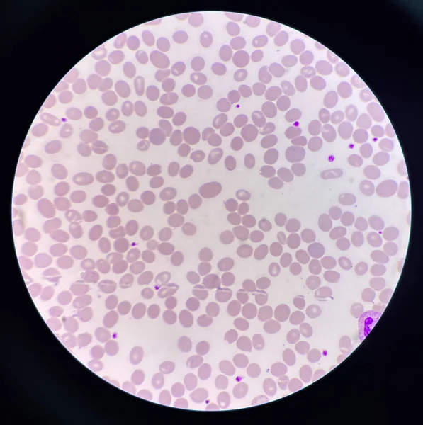 Rozmaz Krwi Nieprawidłowe Makroowalocyty Komórek — Zdjęcie stockowe
