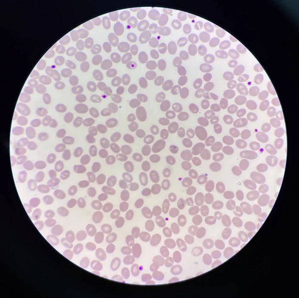 Esfregaço Sanguíneo Macro Ovalócito Células Anormais — Fotografia de Stock