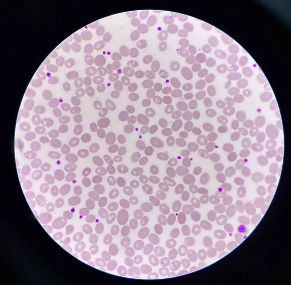 Esfregaço Sanguíneo Macro Ovalócito Células Anormais — Fotografia de Stock