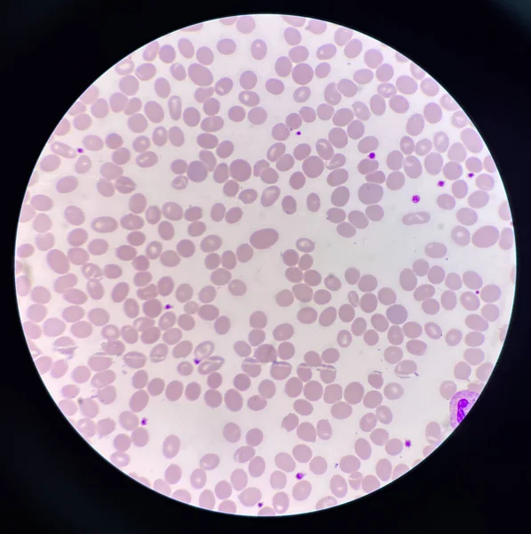 Esfregaço Sanguíneo Macro Ovalócito Células Anormais Imagem De Stock