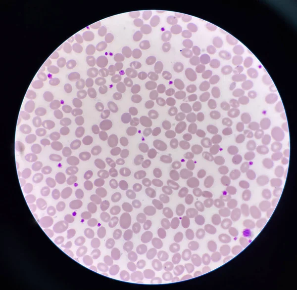 Esfregaço Sanguíneo Macro Ovalócito Células Anormais Imagens Royalty-Free