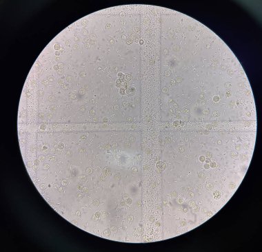 İdrar örneğinde taze bakteri hücresi.