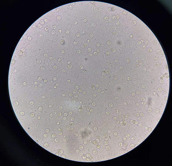 stock image Fresh bacteria cell in urine sample.