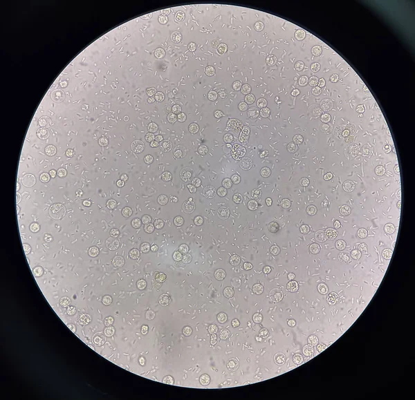 İdrar örneğinde taze bakteri hücresi.