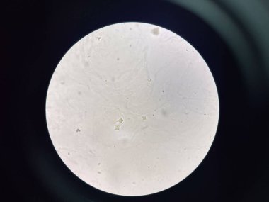 İdrar torbasında kalsiyum oksalat kristali.