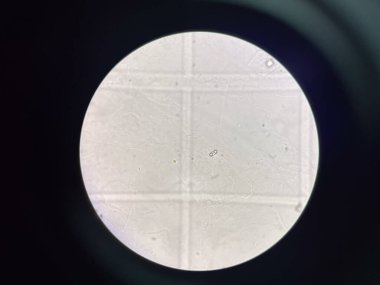 İdrar torbasında kalsiyum oksalat kristali.