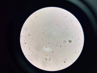 İdrar torbasında ürik asit kristalleri.