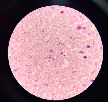 Hemokültüre sahip maya hücresi gram boyası.