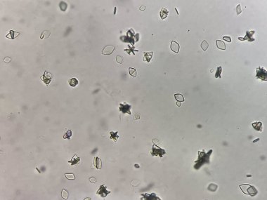 İdrarda Ürik asit kristali.