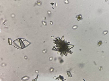 İdrarda Ürik asit kristali.