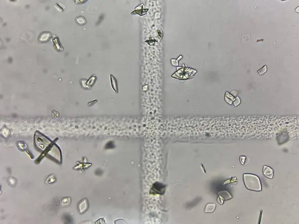 stock image Uric acid crystal in urine.