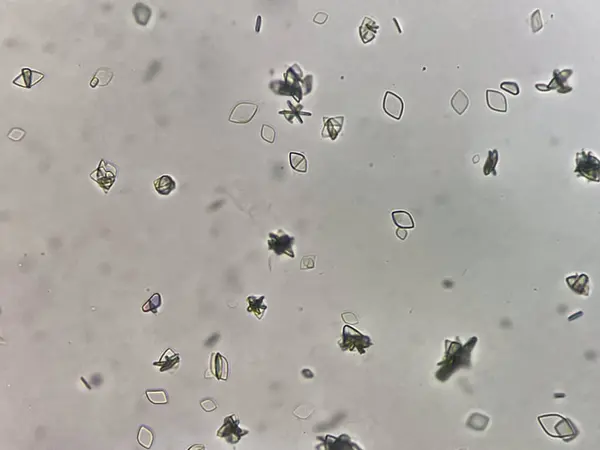 stock image Uric acid crystal in urine.