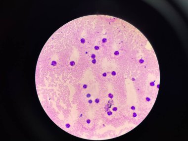 Slayt çok sayıda beyaz kan hücresi gösteriyor, yuvarlak ya da düzensiz şekilli hücreler olarak farklı çekirdeklere sahipler. Bu hücreler tüm alana dağılmış durumda. Bu da yüksek bir bağışıklık sistemi olduğunu gösteriyor..