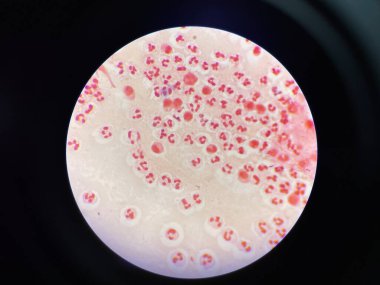 Slayt çok sayıda beyaz kan hücresi gösteriyor, yuvarlak ya da düzensiz şekilli hücreler olarak farklı çekirdeklere sahipler. Bu hücreler tüm alana dağılmış durumda. Bu da yüksek bir bağışıklık sistemi olduğunu gösteriyor..