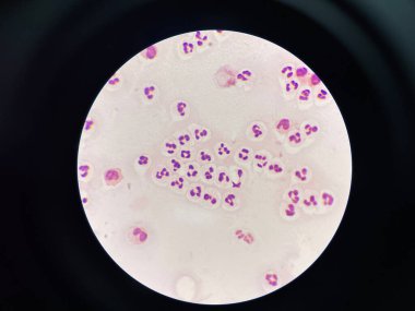 Slayt çok sayıda beyaz kan hücresi gösteriyor, yuvarlak ya da düzensiz şekilli hücreler olarak farklı çekirdeklere sahipler. Bu hücreler tüm alana dağılmış durumda. Bu da yüksek bir bağışıklık sistemi olduğunu gösteriyor..