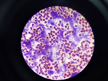 Slayt çok sayıda beyaz kan hücresi gösteriyor, yuvarlak ya da düzensiz şekilli hücreler olarak farklı çekirdeklere sahipler. Bu hücreler tüm alana dağılmış durumda. Bu da yüksek bir bağışıklık sistemi olduğunu gösteriyor..