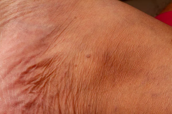 human skin texture. Flat wart on skin micro photo. close up photo.