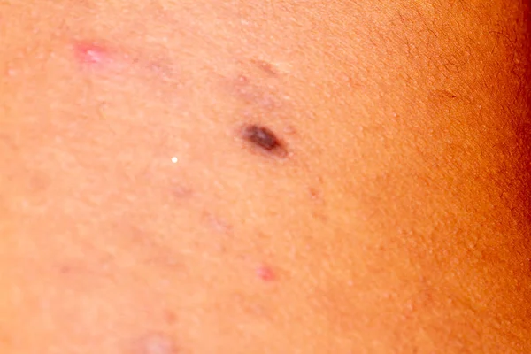 human skin texture. wart and pimples on skin micro photo. close up photo.