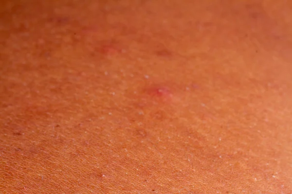 human skin texture. pimples on skin micro photo. close up photo.