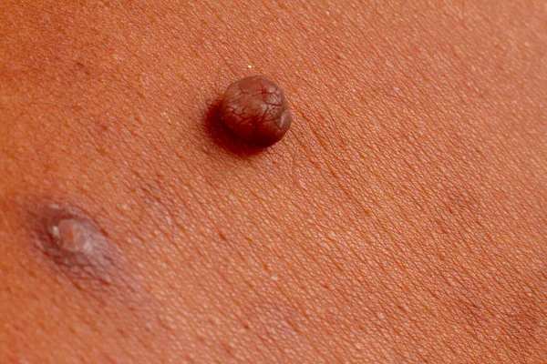 human skin texture. wart and pimples on skin micro photo. close up photo.