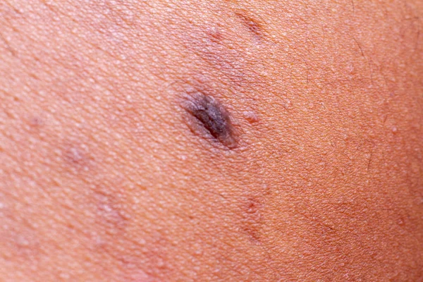 human skin texture. wart and pimples on skin micro photo. close up photo.