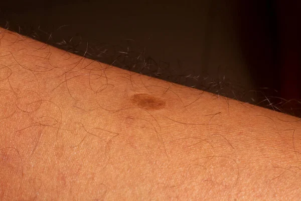 human skin texture. Flat wart on skin micro photo. close up photo.