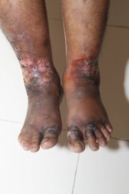 Beyaz arka planda kronik sedef hastalığından muzdarip bir kadının bacakları. Hastanın cildinde kızarıklık ve pullanma var. Dermatolojik sorunlar. Kuru cilt. İzole edilmiş