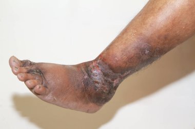 Beyaz arka planda kronik sedef hastalığından muzdarip bir kadının bacakları. Hastanın cildinde kızarıklık ve pullanma var. Dermatolojik sorunlar. Kuru cilt. İzole edilmiş