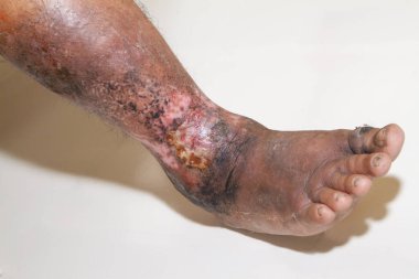 Beyaz arka planda kronik sedef hastalığından muzdarip bir kadının bacakları. Hastanın cildinde kızarıklık ve pullanma var. Dermatolojik sorunlar. Kuru cilt. İzole edilmiş