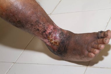Beyaz arka planda kronik sedef hastalığından muzdarip bir kadının bacakları. Hastanın cildinde kızarıklık ve pullanma var. Dermatolojik sorunlar. Kuru cilt. İzole edilmiş