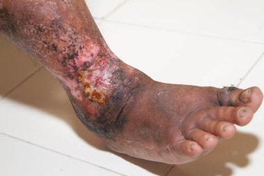 Beyaz arka planda kronik sedef hastalığından muzdarip bir kadının bacakları. Hastanın cildinde kızarıklık ve pullanma var. Dermatolojik sorunlar. Kuru cilt. İzole edilmiş