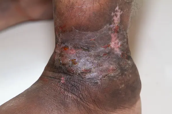Closeup of the legs of a woman suffering from chronic psoriasis on a white background. Closeup of rash and scaling on the patient's skin. Dermatological problems. Dry skin. Isolated