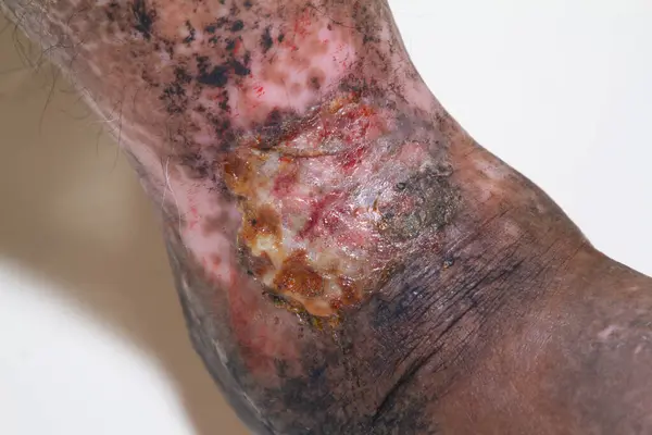 Closeup of the legs of a woman suffering from chronic psoriasis on a white background. Closeup of rash and scaling on the patient\'s skin. Dermatological problems. Dry skin. Isolated