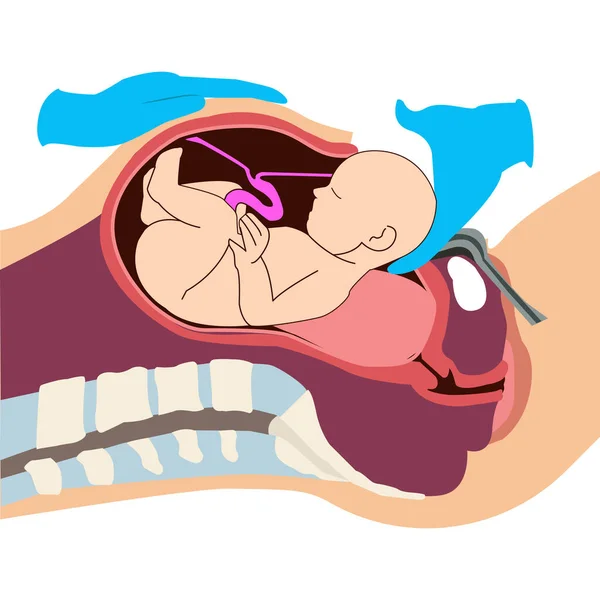 分娩时通过剖腹产取出婴儿 剖腹产期间胎儿的运动 生物学和妇科 — 图库矢量图片