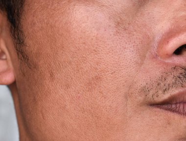 Güneydoğu Asya, Myanmar ya da Koreli yetişkin adamın yüzünde geniş gözenekli açık tenli..