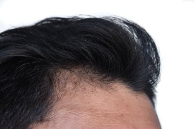 Thinning or sparse hair, male pattern hair loss in Southeast Asian, Chinese young man.