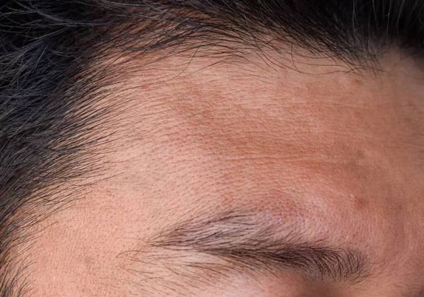 Skin Creases Wrinkles Forehead Southeast Asian Myanmar Burmese Man Symptom — Stock Photo, Image