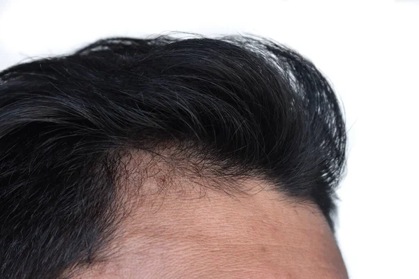 Thinning Sparse Hair Male Pattern Hair Loss Southeast Asian Chinese — Stok fotoğraf