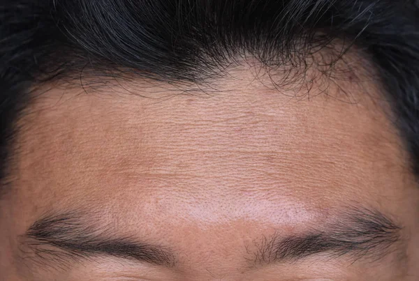 Skin creases or wrinkles at the forehead of Southeast Asian, Myanmar or Burmese man. Symptom of aging.