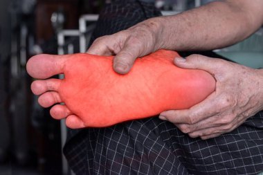 Diyabet hastası Asyalı yaşlı adamın ayağında karıncalanma ve yanma hissi. Ayak ağrısı. Duyusal nöropati sorunları. Ayak sinirleri problemleri. Plantar fasiiti..