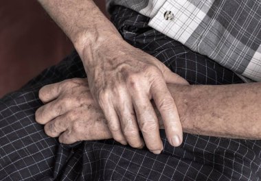 Asyalı yaşlı adamın ellerinde yaş lekeleri var. Bunlar kahverengi, gri veya siyah noktalardır ve ayrıca karaciğer lekeleri, bunak mercimek, güneş mercimeği veya güneş lekeleri olarak da adlandırılır. Eklem iltihabı, romatizma, gut, eklem ağrısı vs..