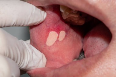 Aphthous ulcer or stress ulcer in mouth of Asian male patient.
